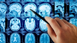 Un nuevo estudio abre camino a la detección precoz de la metástasis cerebral