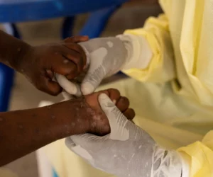 Cabo Verde reforzará la vigilancia en las entradas al país ante el brote de mpox