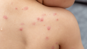 España donará a África 100.000 viales para vacunar a 500.000 personas contra la mpox