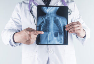 OMS advierte sobre los peligros de los recortes financieros en la lucha contra la tuberculosis