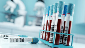 Un análisis de sangre muestra una alta precisión en la detección del alzhéimer